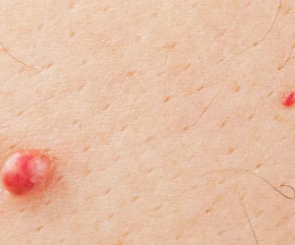 Genital Siğil ve Et Beni Farkı Nedir?