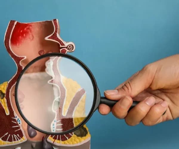 Fistülotomi Nedir? Nasıl Yapılır? Riskleri Nelerdir?