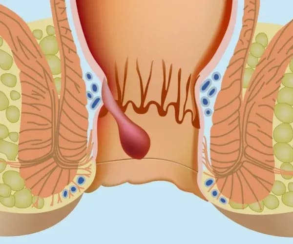 Anal Apse Tedavisinde Antibiyotik Yeterli mi?