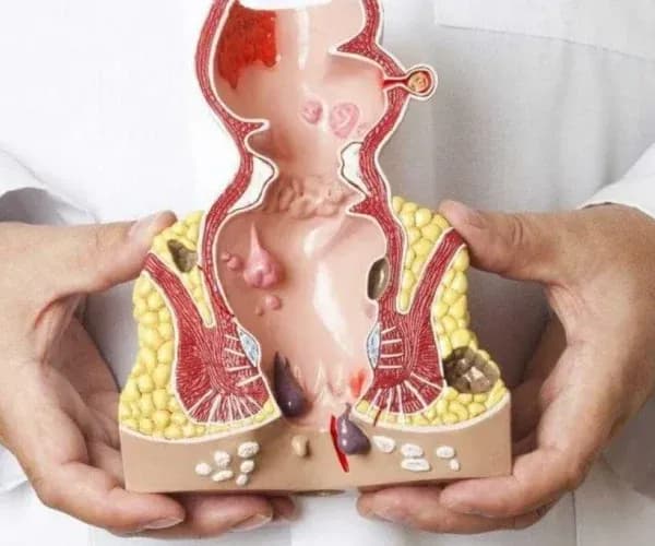 Hemoroid İçin Hangi Bölüme Gidilir?