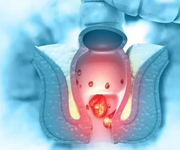 Hemoroid İlk Muayenesi Nasıl Yapılır?