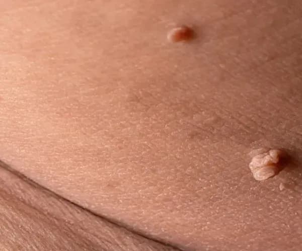 Genital Siğil