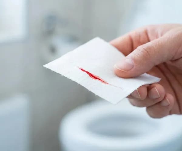 Hemoroid mi Fissür mü Nasıl Ayırt Edilir?