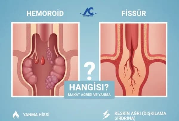 Makat Ağrısı ve Yanma: Hemoroid mi, Fissür mü? Belirtiler ve Tedavi Yaklaşımı