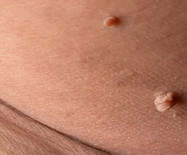 Genital Siğil