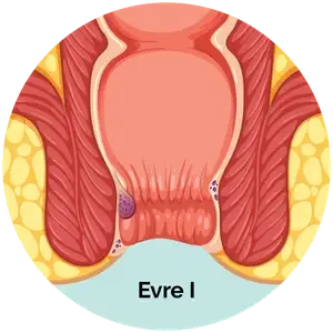 Evre 1 Hemoroid
