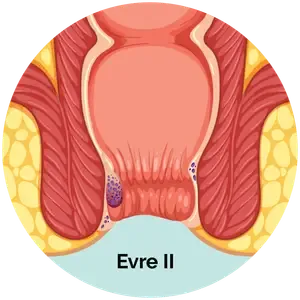 Evre 2 Hemoroid
