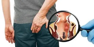 hemoroid basur agrısı