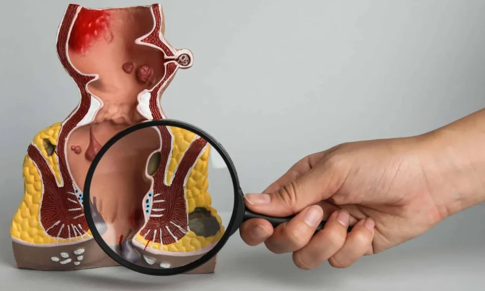 Extrasfinkterik Anal Fistül Nedir? Tedavisi Nasıl Yapılır?