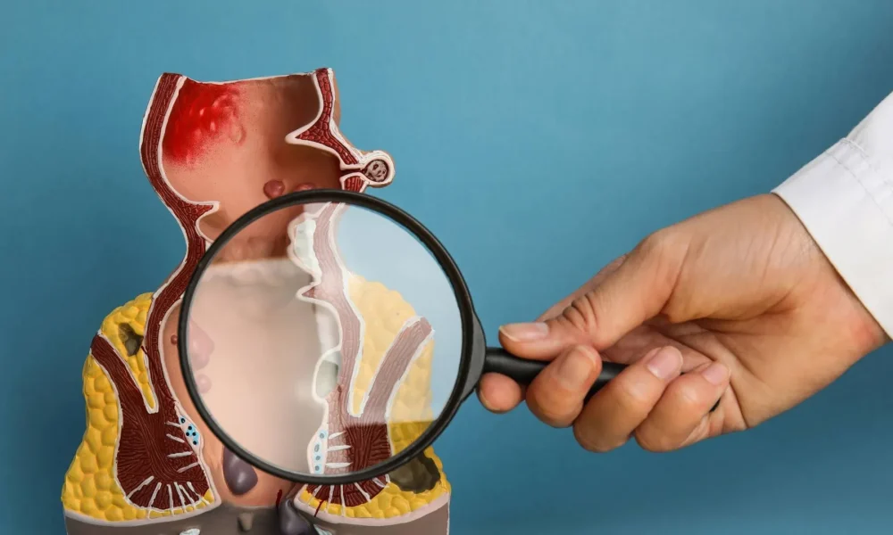 Fistülotomi Nedir? Nasıl Yapılır? Riskleri Nelerdir?
