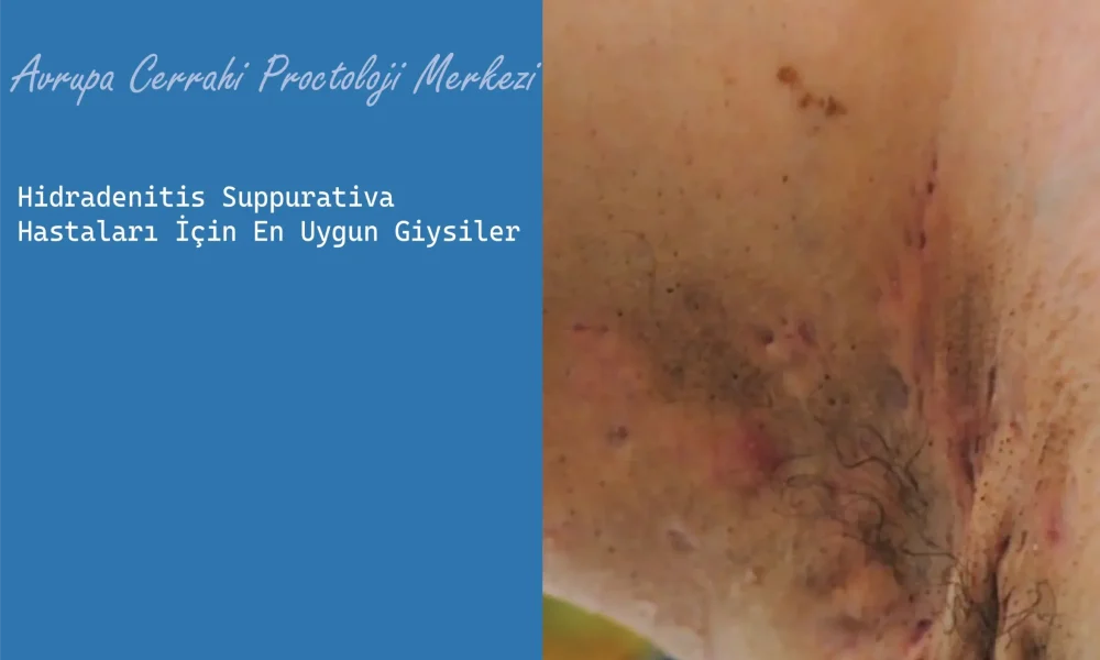 Hidradenitis Suppurativa Hastaları İçin En Uygun Giysiler