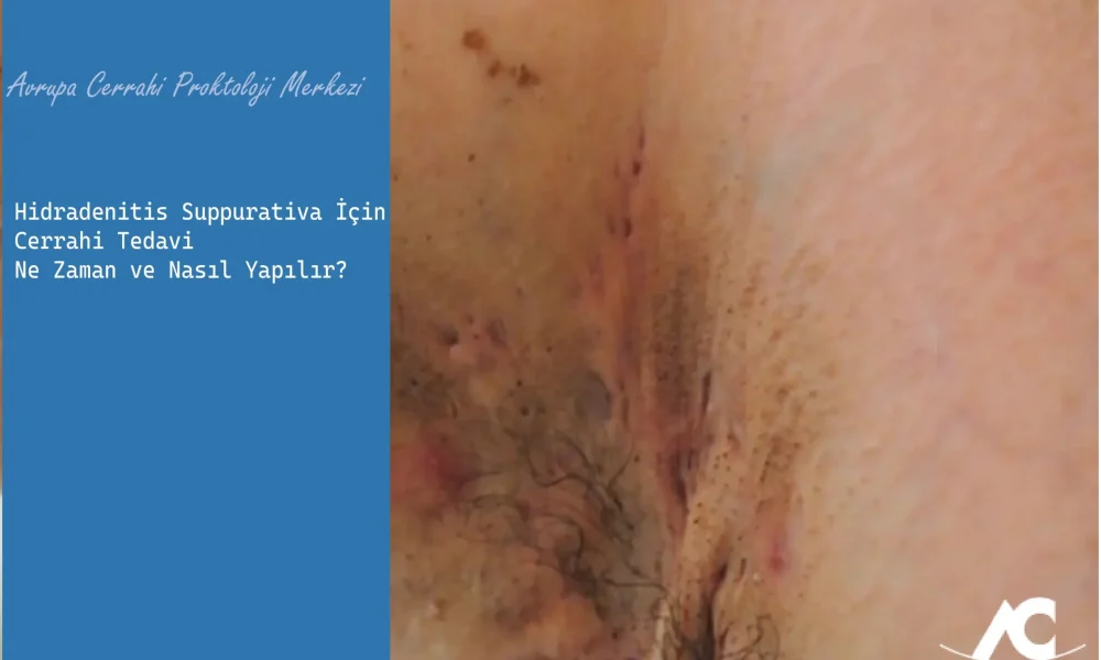 Hidradenitis Suppurativa İçin Cerrahi Tedavi Ne Zaman ve Nasıl Yapılır