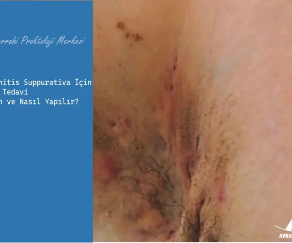 Hidradenitis Suppurativa İçin Cerrahi Tedavi Ne Zaman ve Nasıl Yapılır