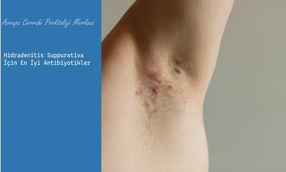 Hidradenitis Suppurativa İçin En İyi Antibiyotikler