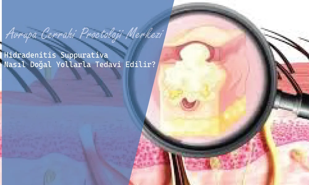 Hidradenitis Suppurativa Nasıl Doğal Yollarla Tedavi Edilir mi
