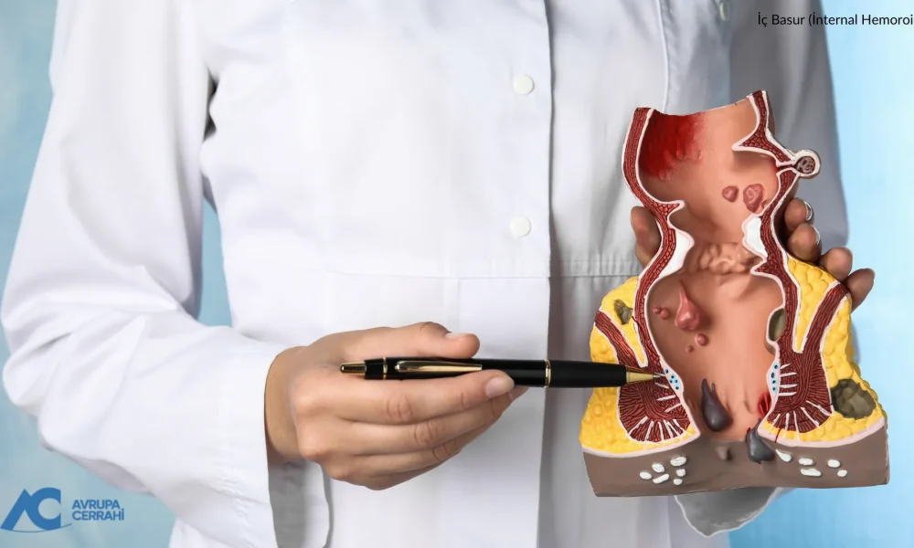 İç Basur (İnternal Hemoroid) Nedir Tedavisi ve Yöntemleri
