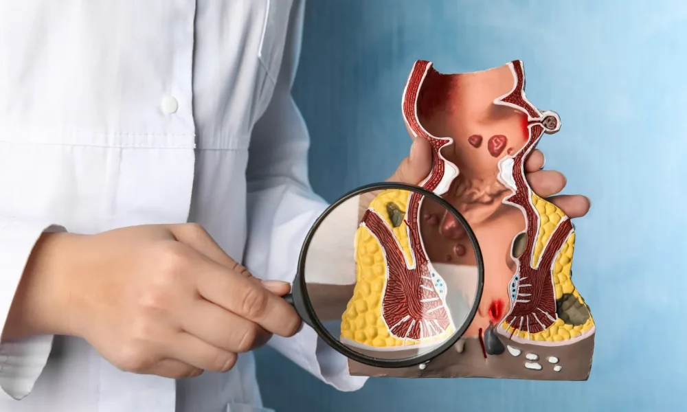 Suprasfinkterik Anal Fistül Nedir? Tedavisi Nasıl Yapılır?