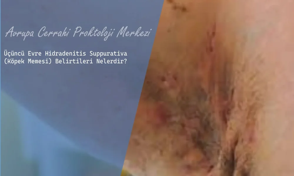 Üçüncü Evre Hidradenitis Suppurativa (Köpek Memesi) Belirtileri