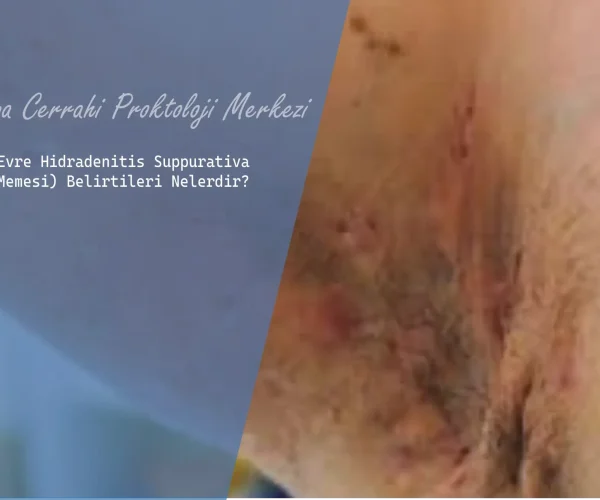 Üçüncü Evre Hidradenitis Suppurativa (Köpek Memesi) Belirtileri