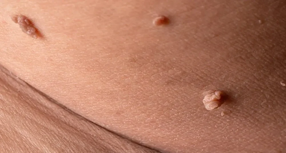 Genital Siğil Nasıl Anlaşılır?
