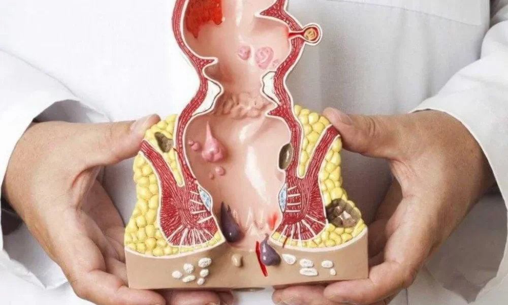 Hemoroid'e Hangi Bölüm Bakar? Tedavisi Nasıl Olur?