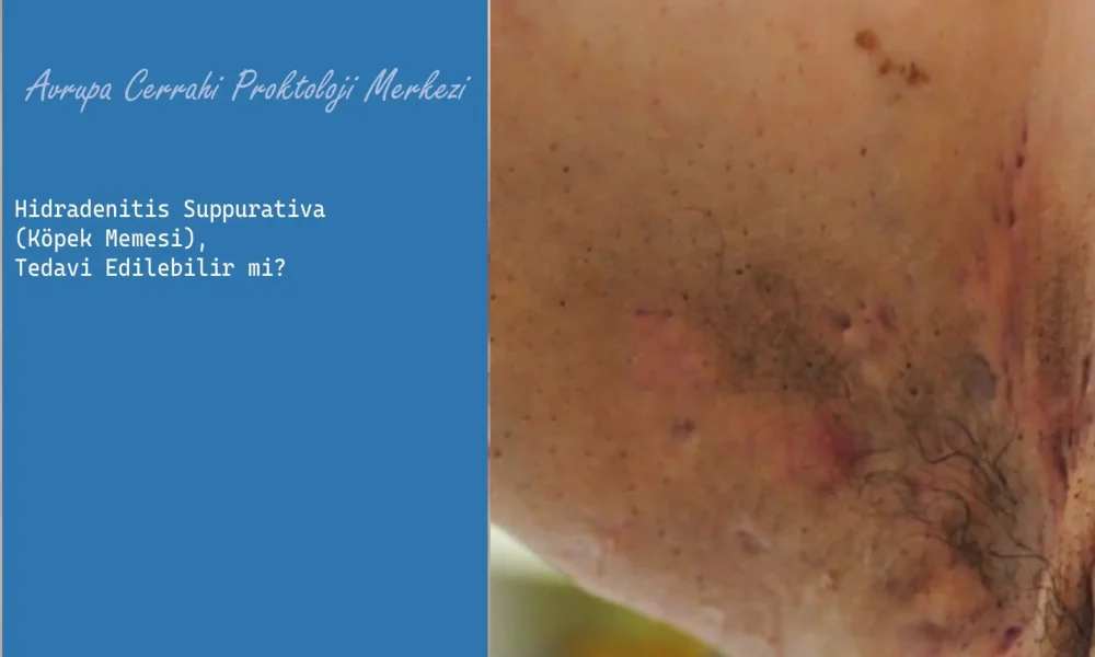 Hidradenitis Suppurativa Tedavi Edilebilir mi