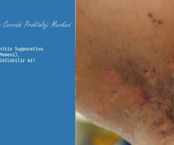 Hidradenitis Suppurativa Tedavi Edilebilir mi
