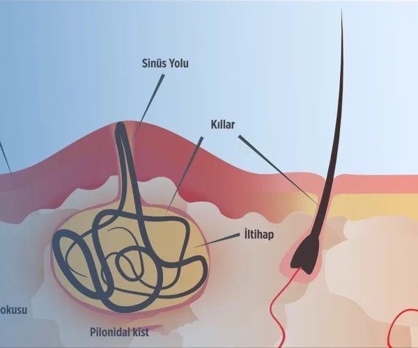 Kıl Dönmesi (Pilonidal sinus) Nedir? Kıl Dönmesi (Pilonidal sinus) Nasıl Tedavi Edilir?