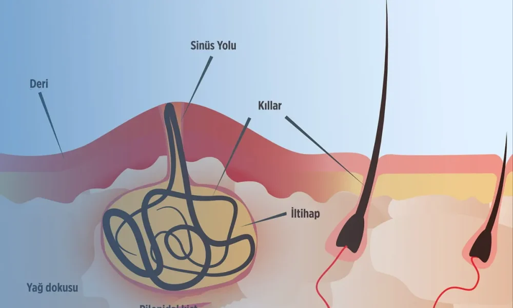 Kıl Dönmesi (Pilonidal sinus) Nedir? Kıl Dönmesi (Pilonidal sinus) Nasıl Tedavi Edilir?