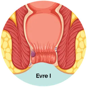 Evre 1 Hemoroid