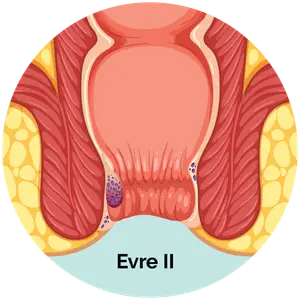 Evre 2 Hemoroid