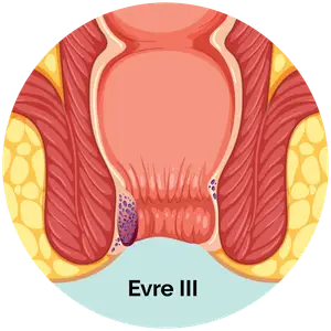 Evre 3 Hemoroid
