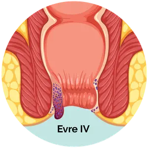 Evre 4 Hemoroid