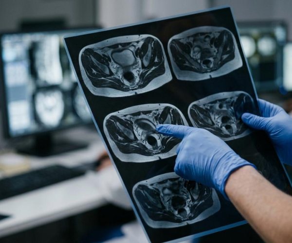 perianal apse sonrası fistül